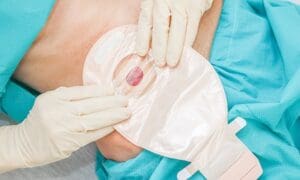 Ostomy Care Registered Nurses